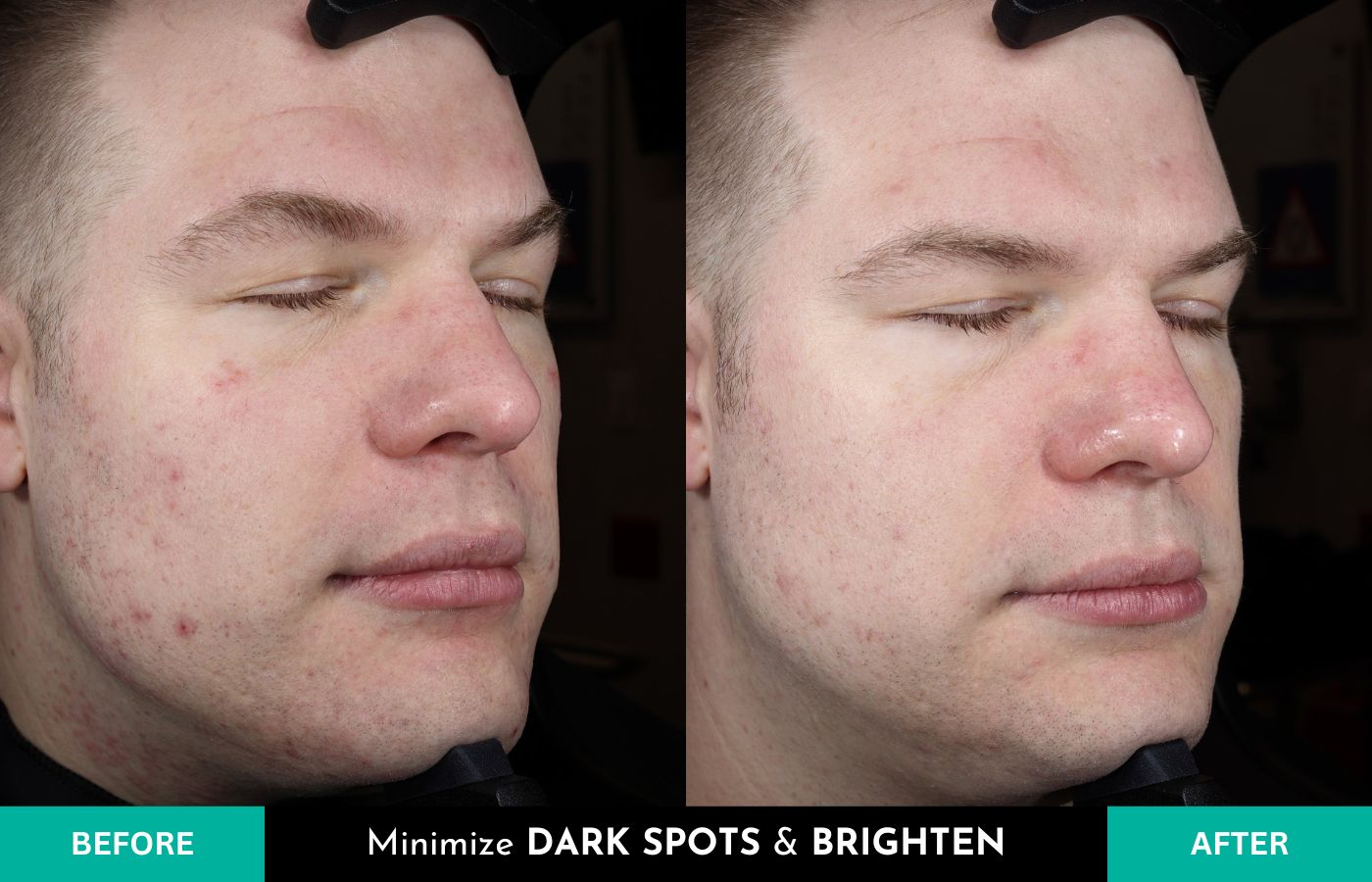 Before and After Plated Daily Serum with Exosomes