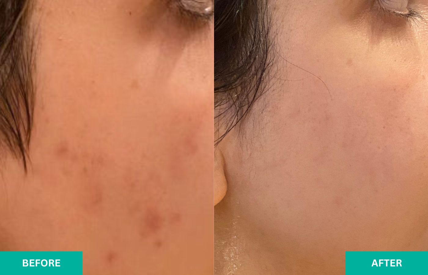 Before and after acne treatment at VERABELLA