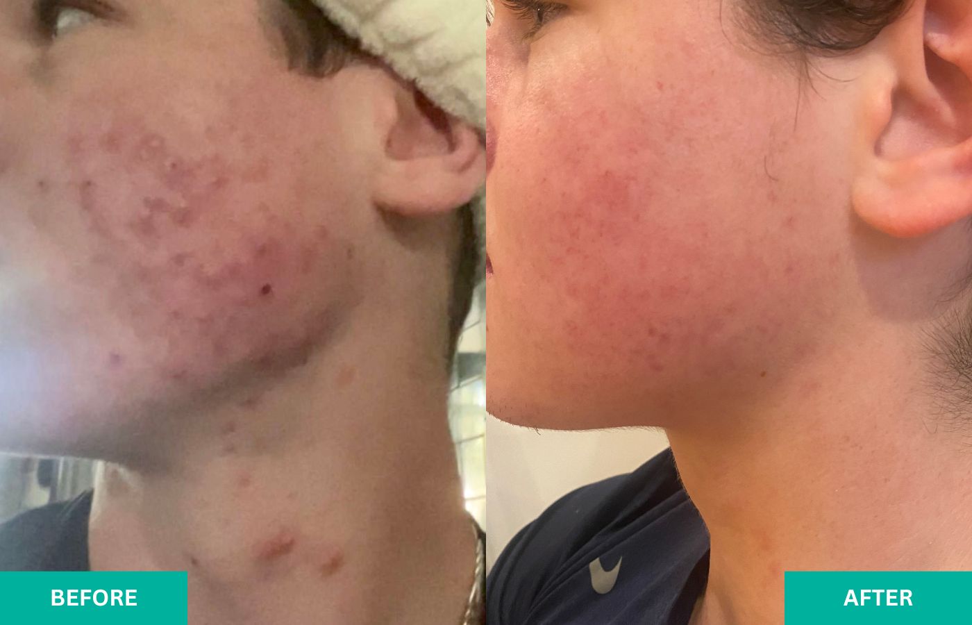 Teen Boy with severe acne at VERABELLA