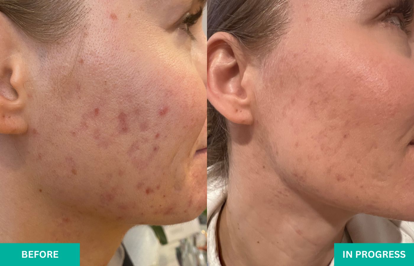 Before and In Progress Shots of VERABELLA Acne Client