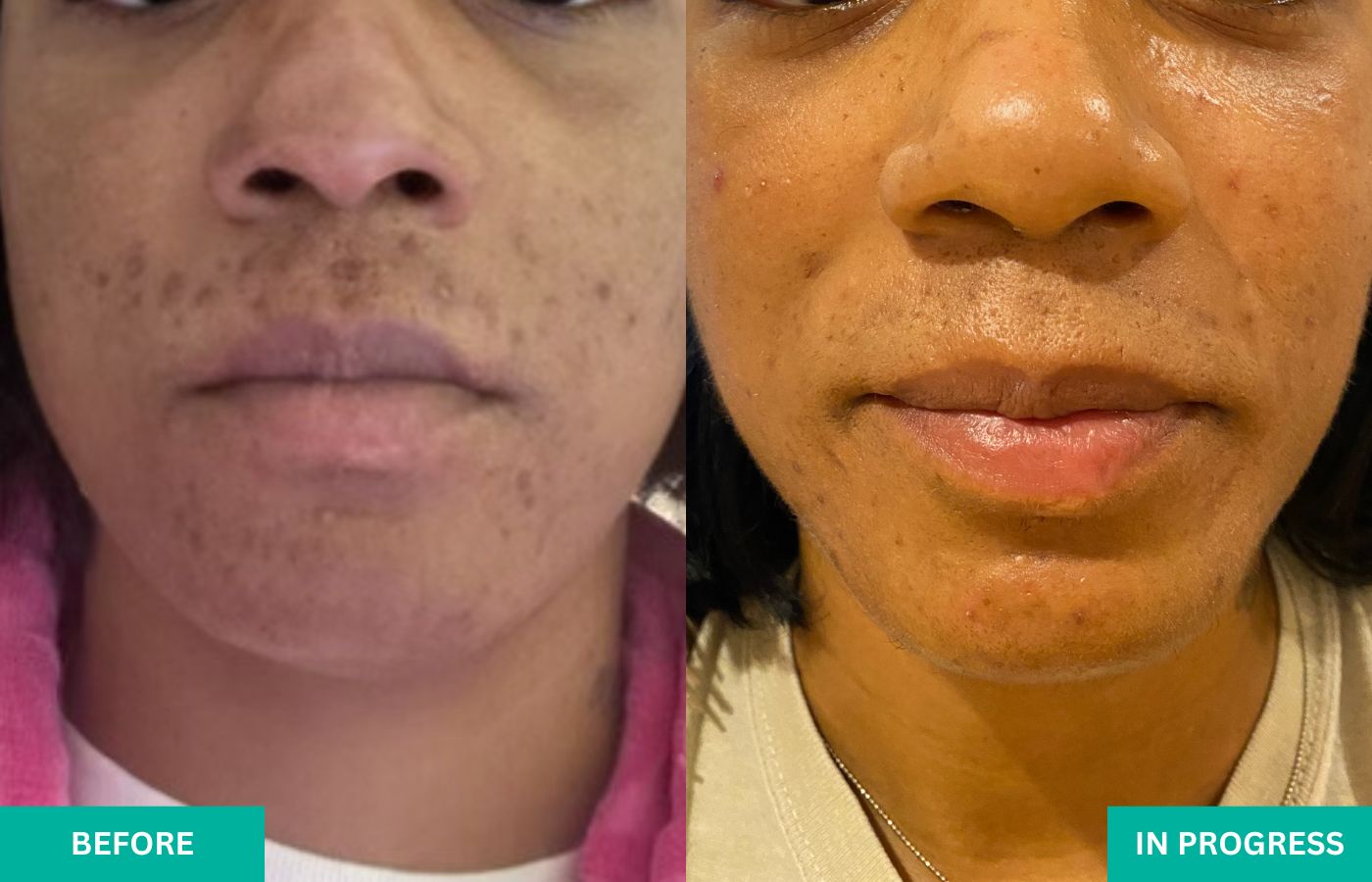 VERABELLA progress photos of hyperpigmentation and scarring from acne