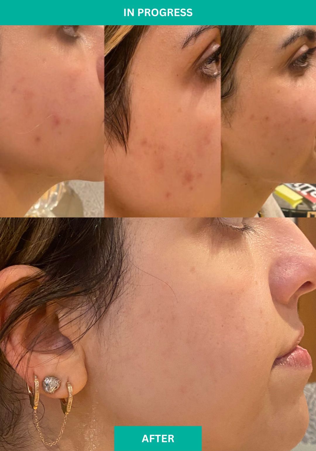 Progress Not Perfection - Tracking Acne Skin Therapy at VERABELLA