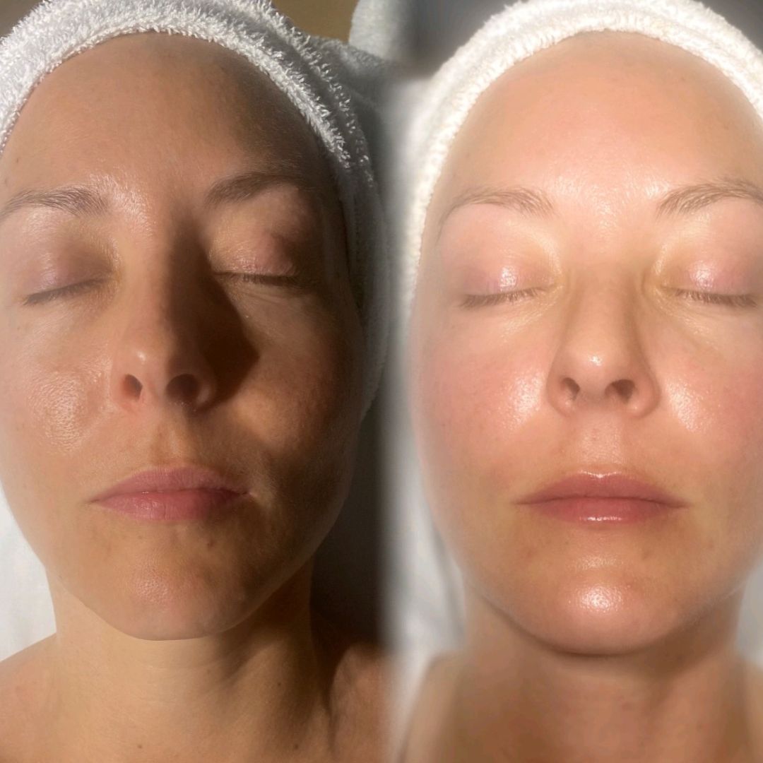 Fall on Your Face Facial - before and after
