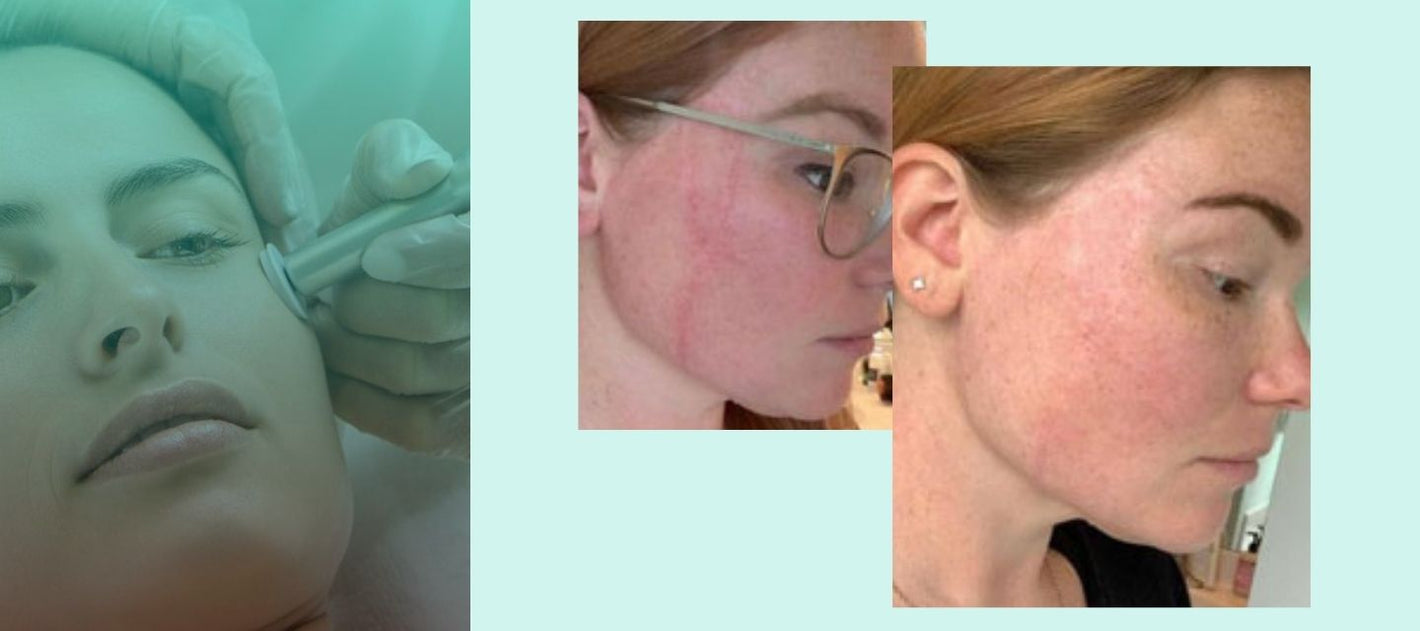 Verabella Skin Therapy Spa - Micro-Channeling before and after