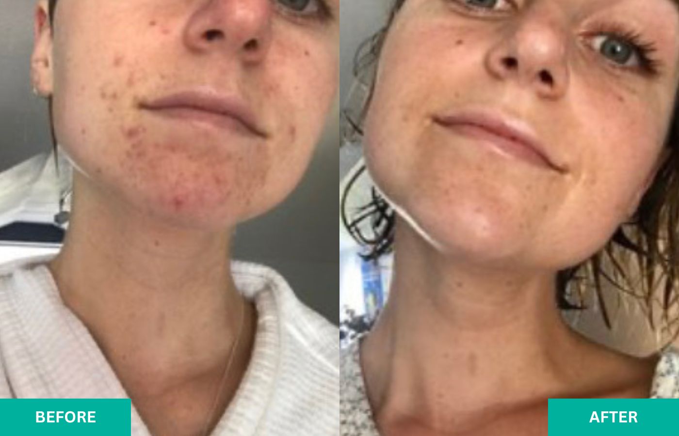 before-and-after-verabella-acne-1