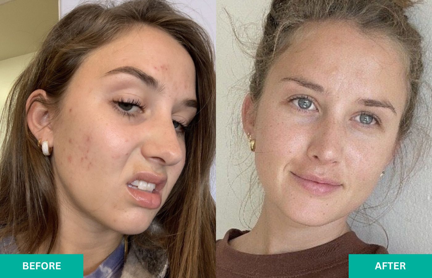 before-and-after-verabella-acne-2
