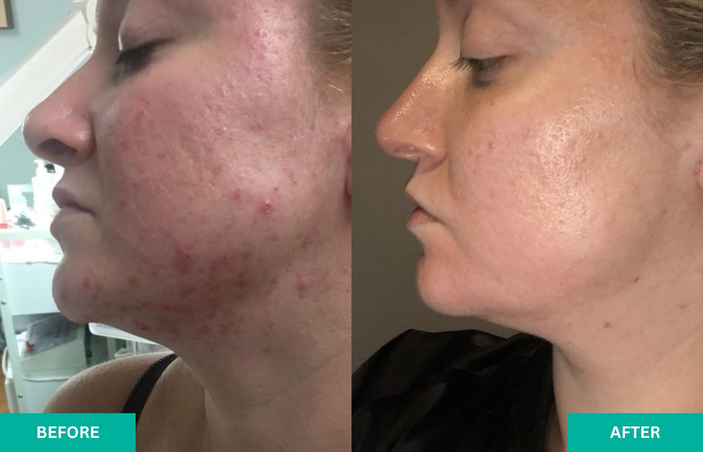 before-and-after-verabella-acne-3