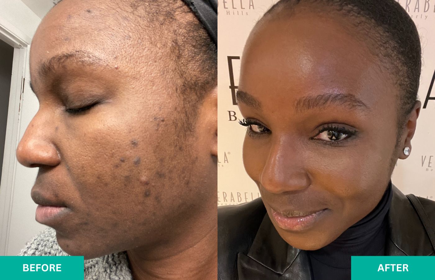 before-and-after-verabella-acne-8